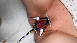 Traditional Nurse Administers Female Patient Electro Shock